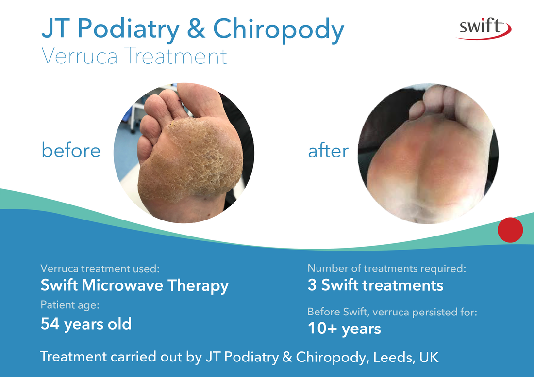 Swift mircowave therapy for stubborn verrucas and warts